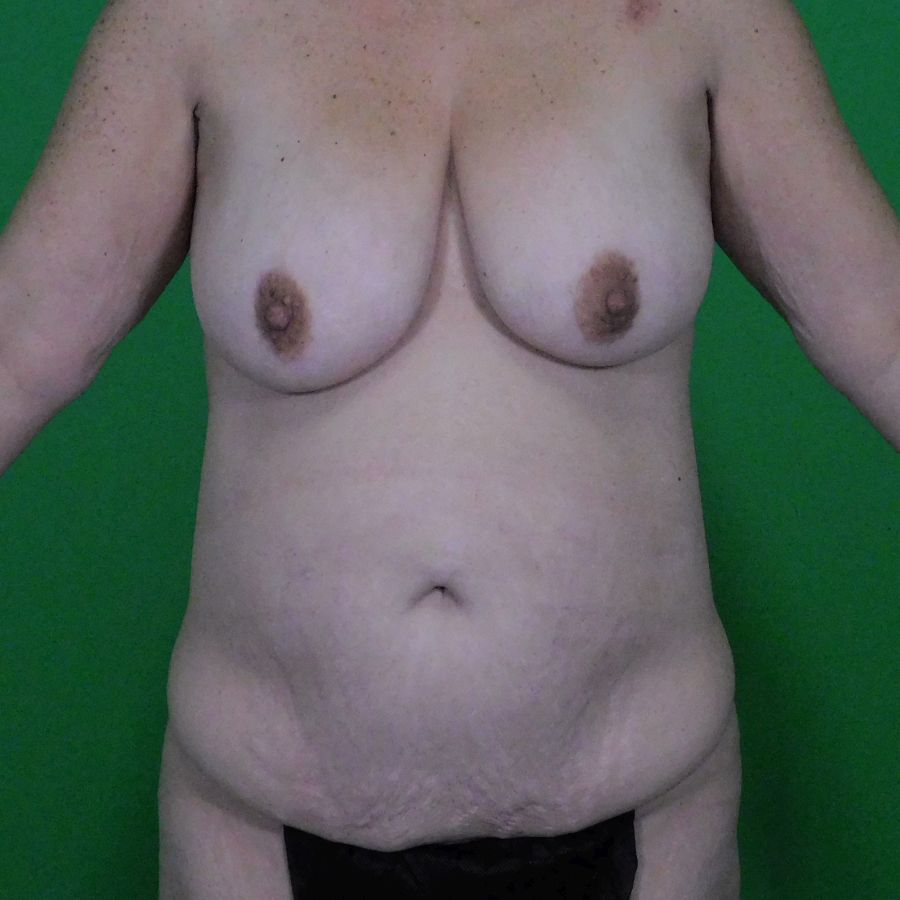 Photo of a female patient before tummy tuck surgery