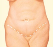Front view of an graphic showing where the incision on the front of the stomach would be